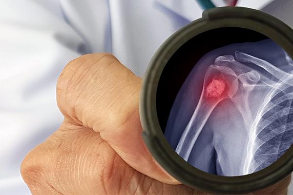 Do Not Underestimate Bone Pain That Keeps You Awake and Does Not Ease With Medication!