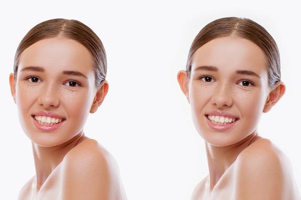 Prominent Ear (Otoplasty)