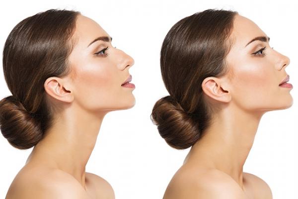 Rhinoplasty