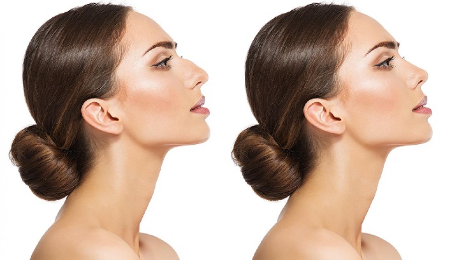 Rhinoplasty